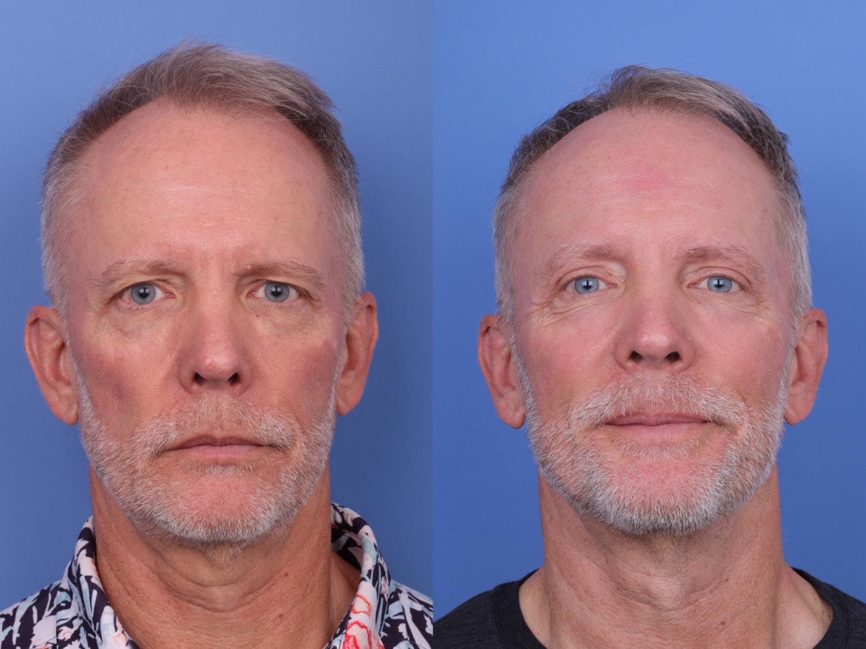 Before & After Blepharoplasty Case 689 Front View in Scottsdale, AZ