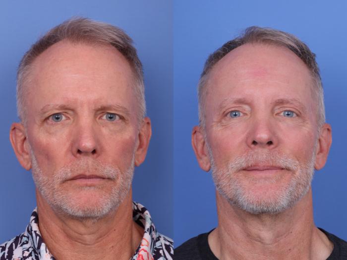 Before & After Blepharoplasty Case 689 Front View in Scottsdale, AZ