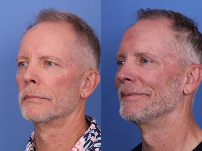 Before & After Blepharoplasty Case 689 Left Oblique View in Scottsdale, AZ