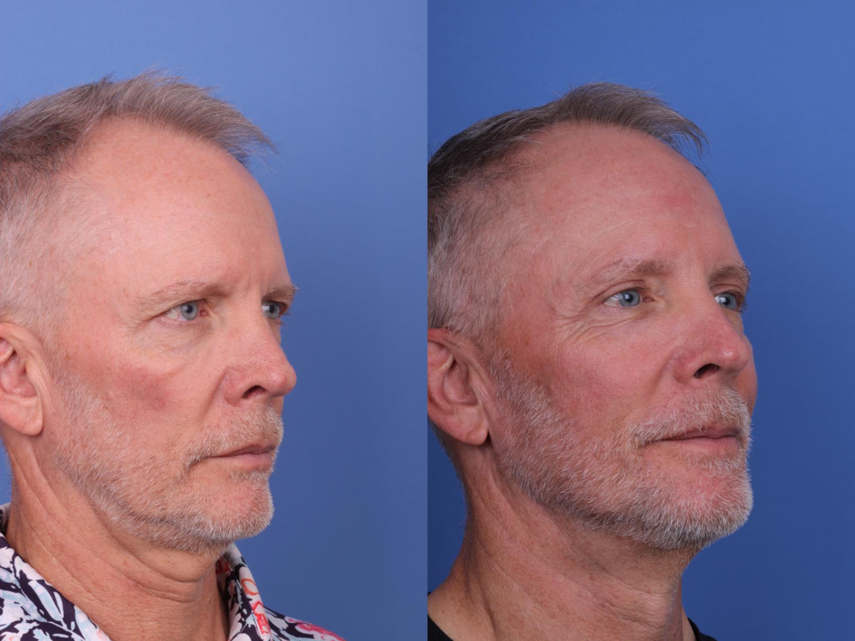Before & After Blepharoplasty Case 689 Right Oblique View in Scottsdale, AZ