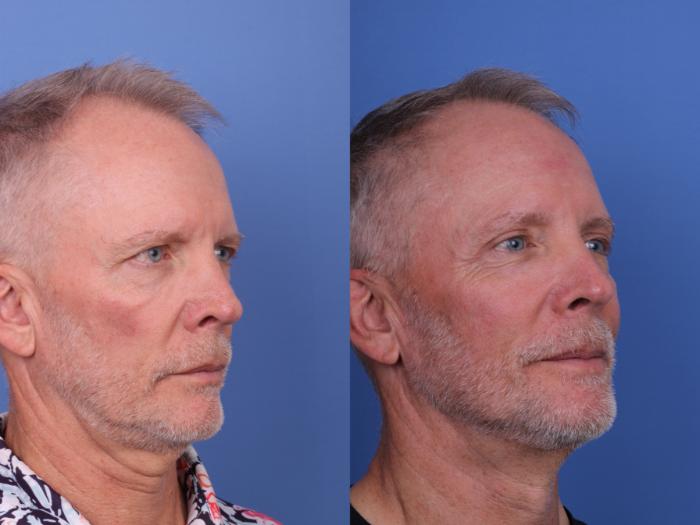Before & After Blepharoplasty Case 689 Right Oblique View in Scottsdale, AZ