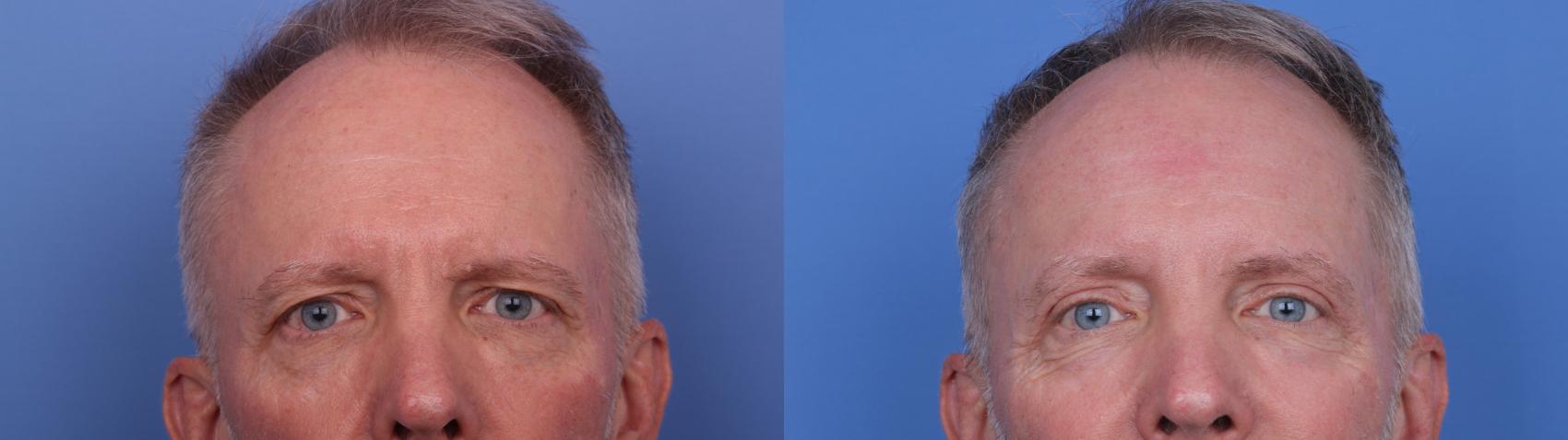 Before & After Blepharoplasty Case 689 Zoom Blepharoplasty View in Scottsdale, AZ