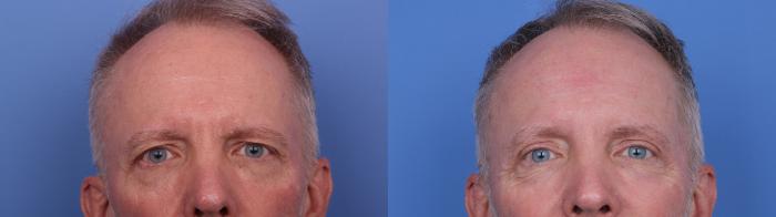 Before & After Blepharoplasty Case 689 Zoom Blepharoplasty View in Scottsdale, AZ