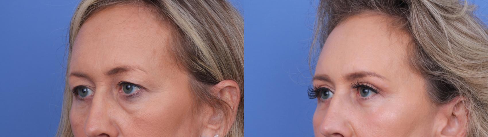 Before & After Blepharoplasty Case 692 Left Oblique View in Scottsdale, AZ