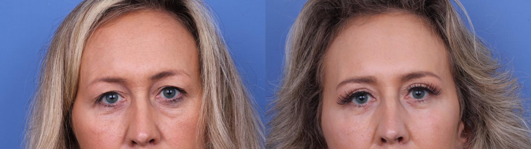 Before & After Blepharoplasty Case 692 Zoom Blepharoplasty View in Scottsdale, AZ