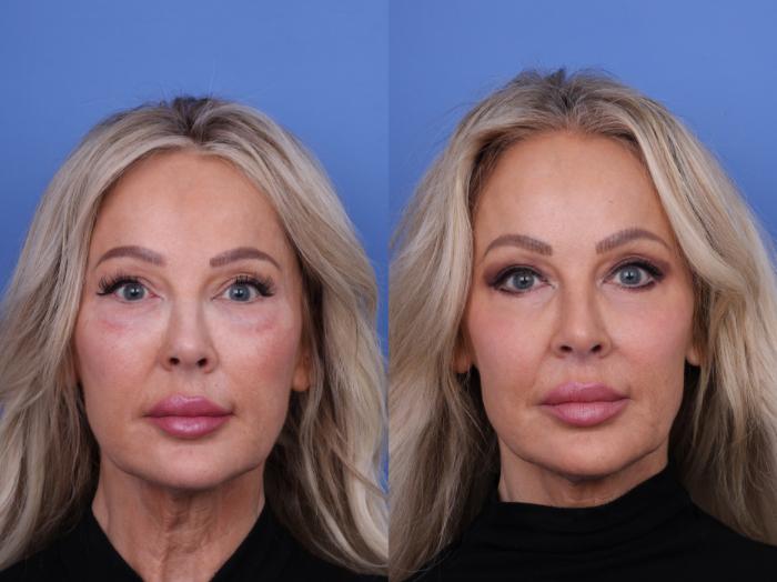 Before & After Blepharoplasty Case 702 Front View in Scottsdale, AZ