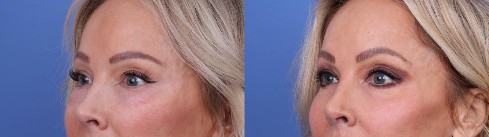 Before & After Blepharoplasty Case 702 Left Oblique View in Scottsdale, AZ