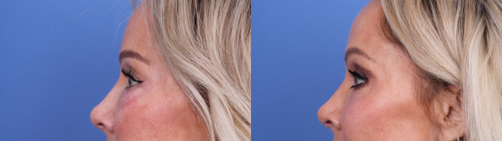Before & After Blepharoplasty Case 702 Left Side View in Scottsdale, AZ