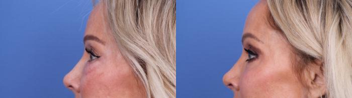 Before & After Blepharoplasty Case 702 Left Side View in Scottsdale, AZ