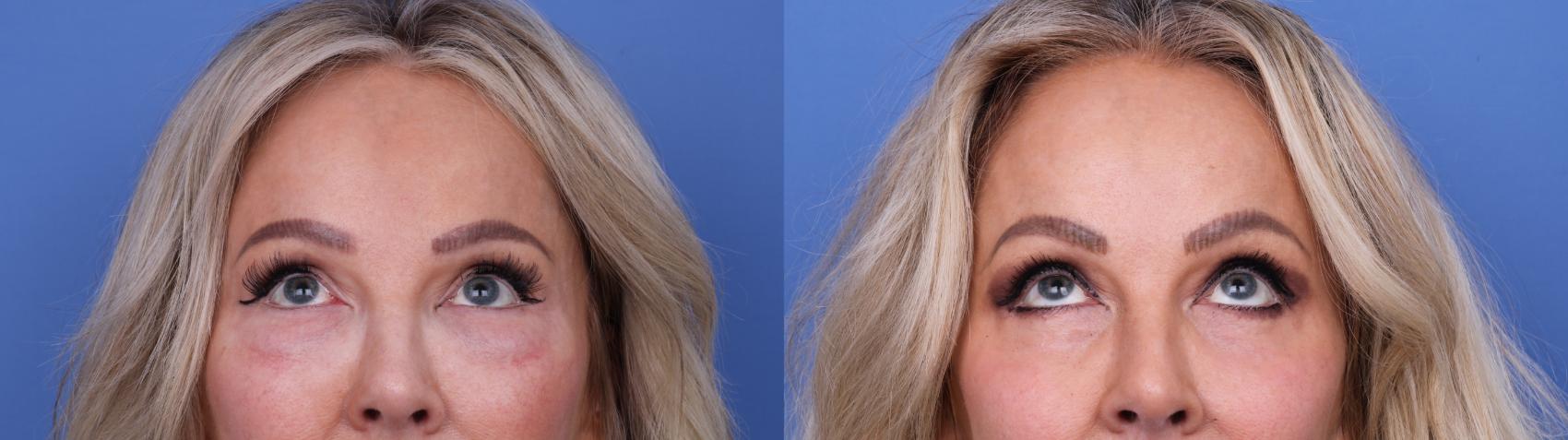 Before & After Blepharoplasty Case 702 Upgaze Blepharoplasty View in Scottsdale, AZ