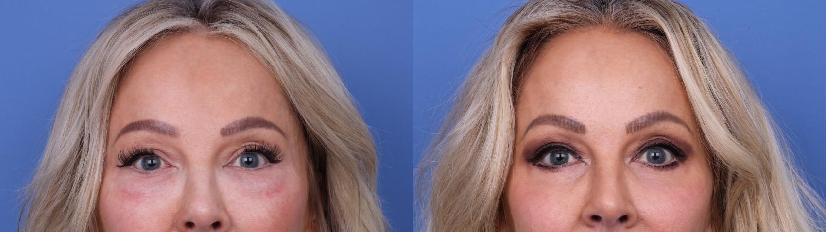 Before & After Blepharoplasty Case 702 Zoom Blepharoplasty View in Scottsdale, AZ