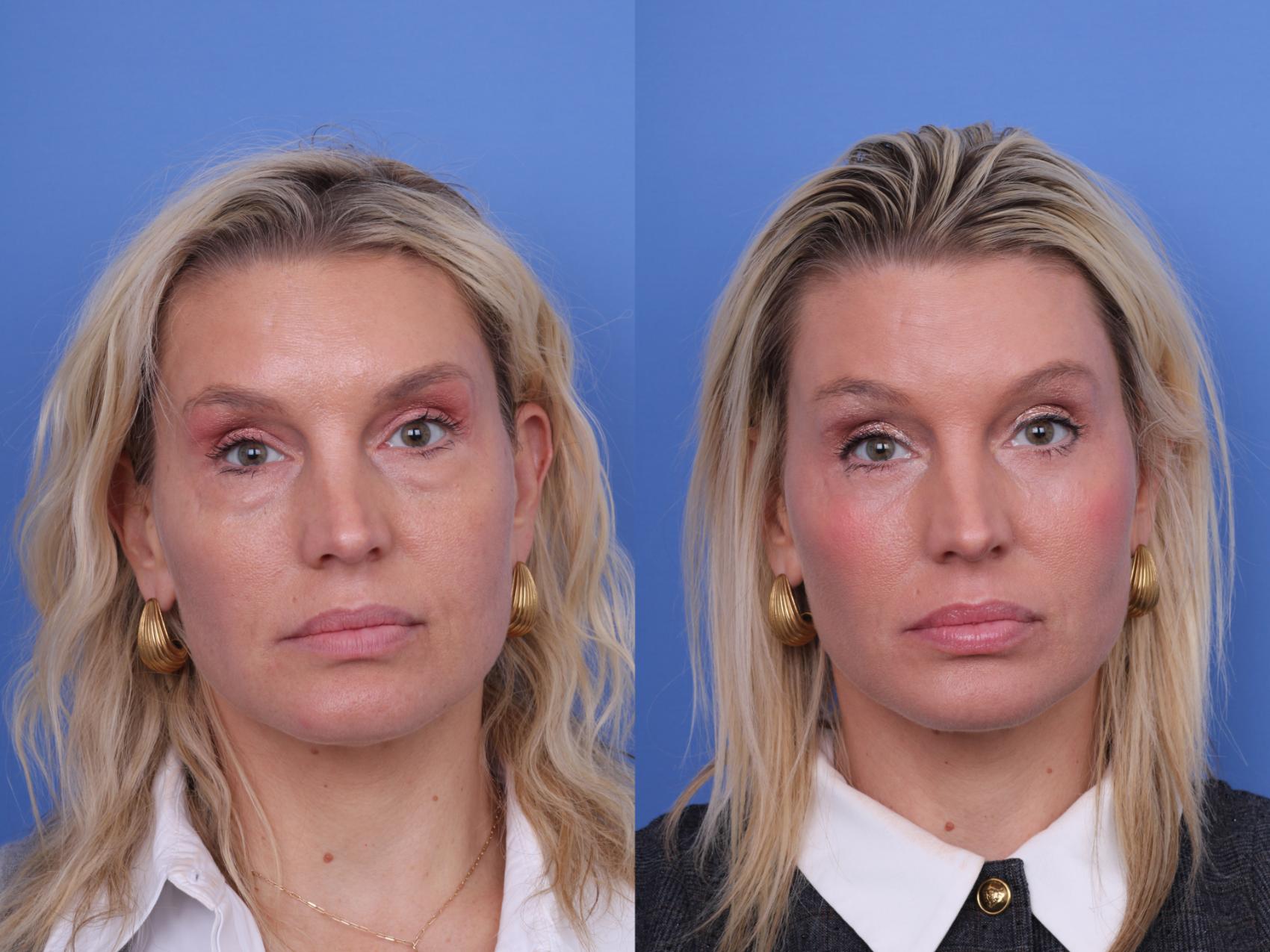 Before & After Blepharoplasty Case 715 Front View in Scottsdale, AZ