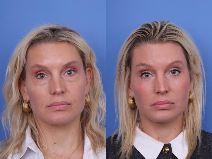 Before & After Blepharoplasty Case 715 Front View in Scottsdale, AZ