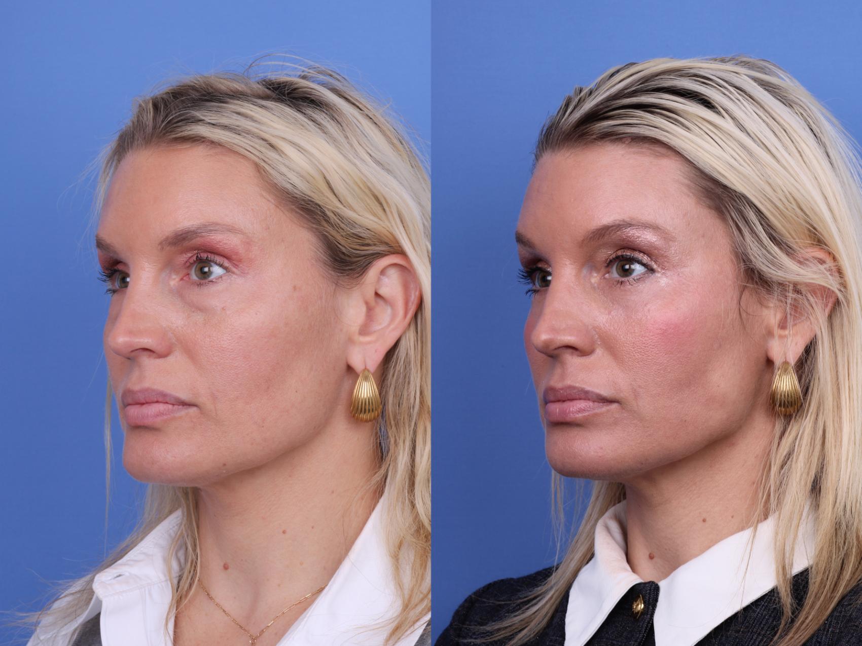 Before & After Blepharoplasty Case 715 Left Oblique View in Scottsdale, AZ