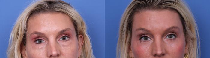 Before & After Blepharoplasty Case 715 Zoom Blepharoplasty View in Scottsdale, AZ