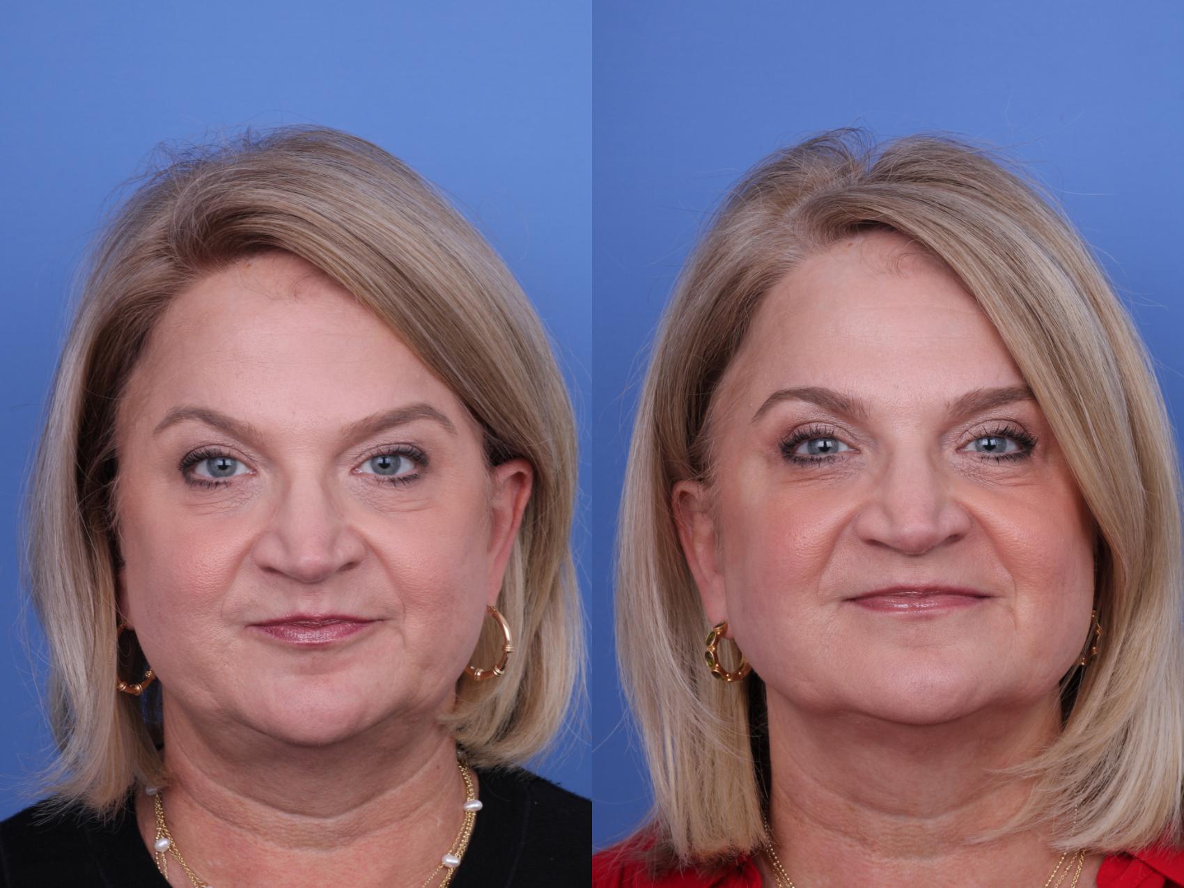 Before & After Blepharoplasty Case 721 Front View in Scottsdale, AZ