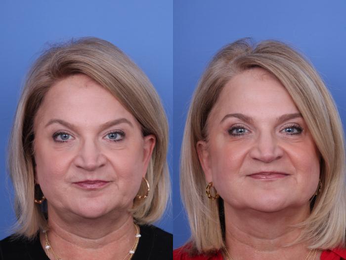 Before & After Blepharoplasty Case 721 Front View in Scottsdale, AZ