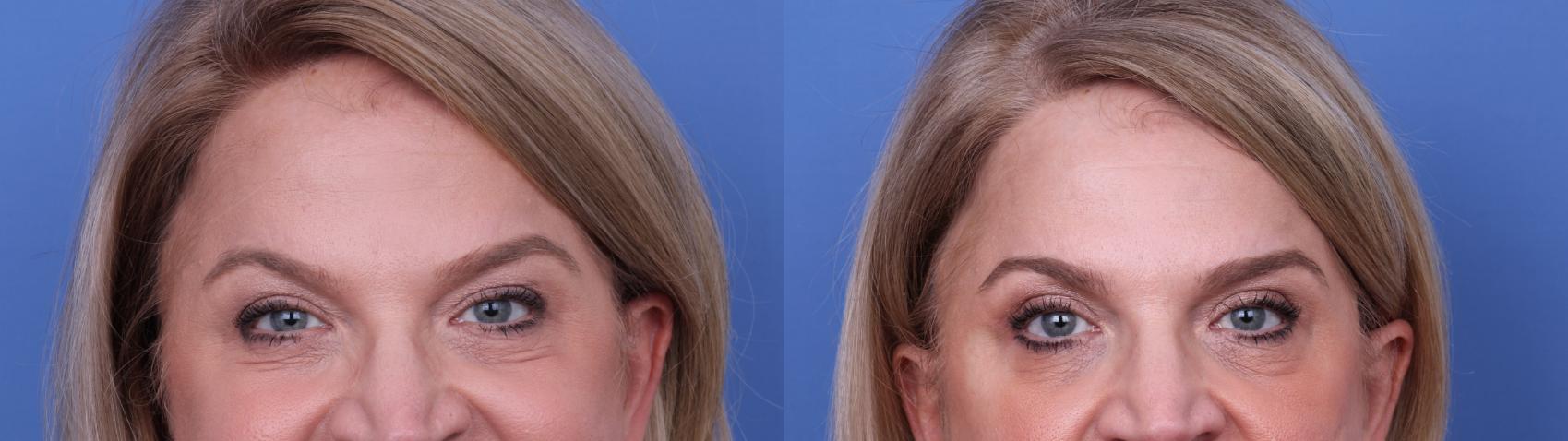 Before & After Blepharoplasty Case 721 Zoom Blepharoplasty View in Scottsdale, AZ