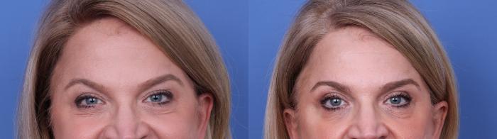 Before & After Blepharoplasty Case 721 Zoom Blepharoplasty View in Scottsdale, AZ