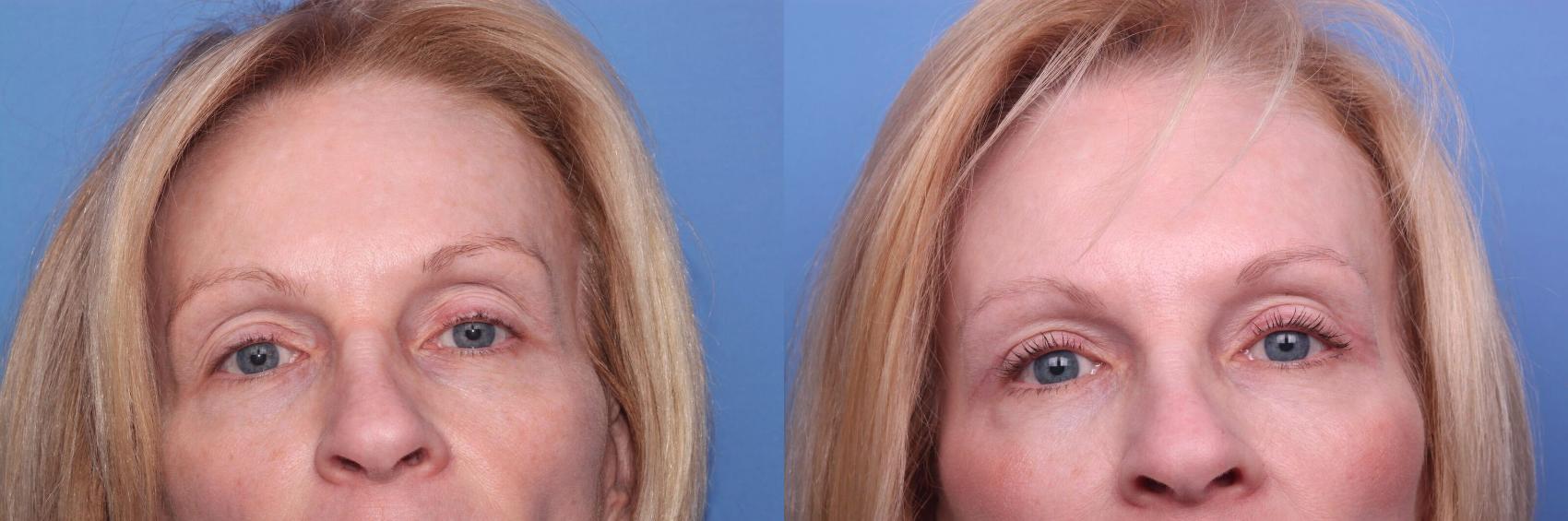 Before & After Blepharoplasty Case 97 View #2 View in Scottsdale, AZ