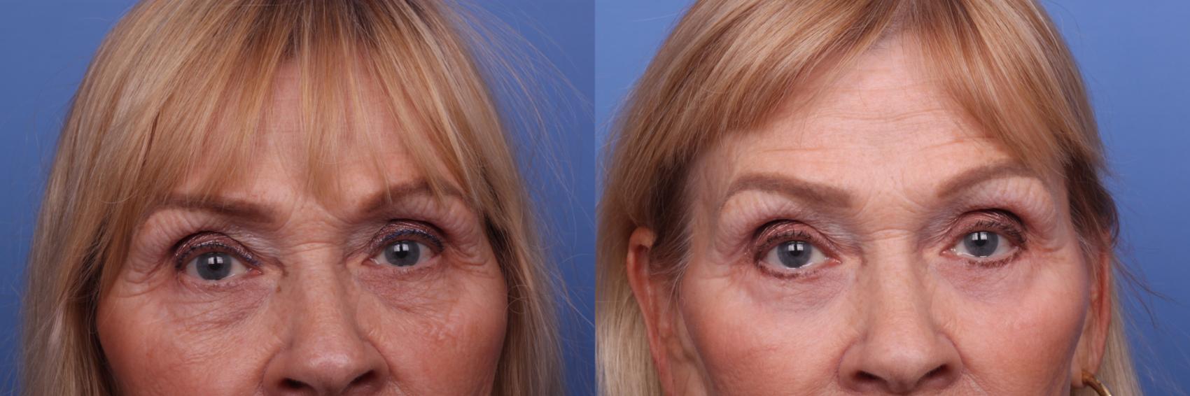 Before & After Brow Lift Case 472 Zoom Bleph View in Scottsdale, AZ