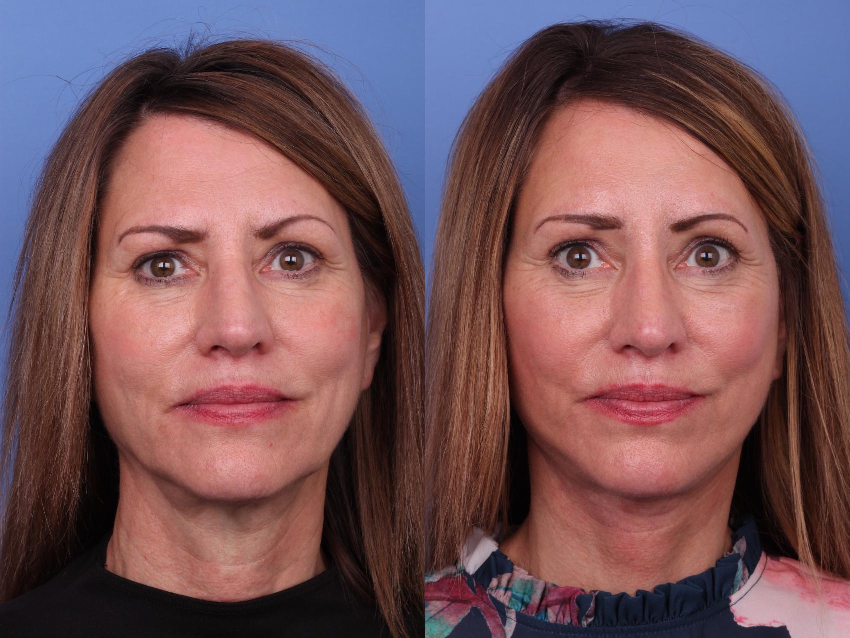 Before & After Facelift Case 589 Front View in Scottsdale, AZ