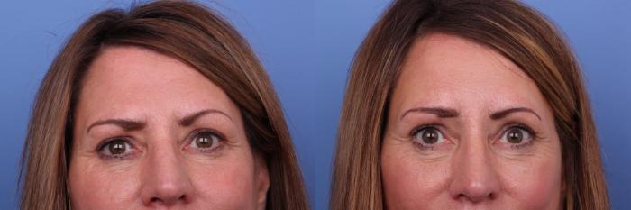 Brow Lift Before & After Photo | Scottsdale & Phoenix, AZ | Hobgood Facial Plastic Surgery: Todd Hobgood, MD