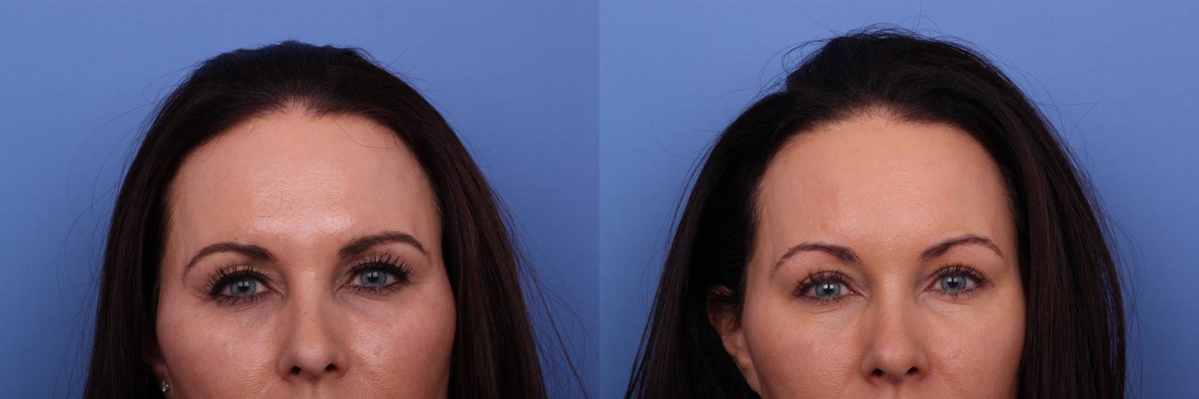 Brow Lift Before & After Photo | Scottsdale & Phoenix, AZ | Hobgood Facial Plastic Surgery: Todd Hobgood, MD