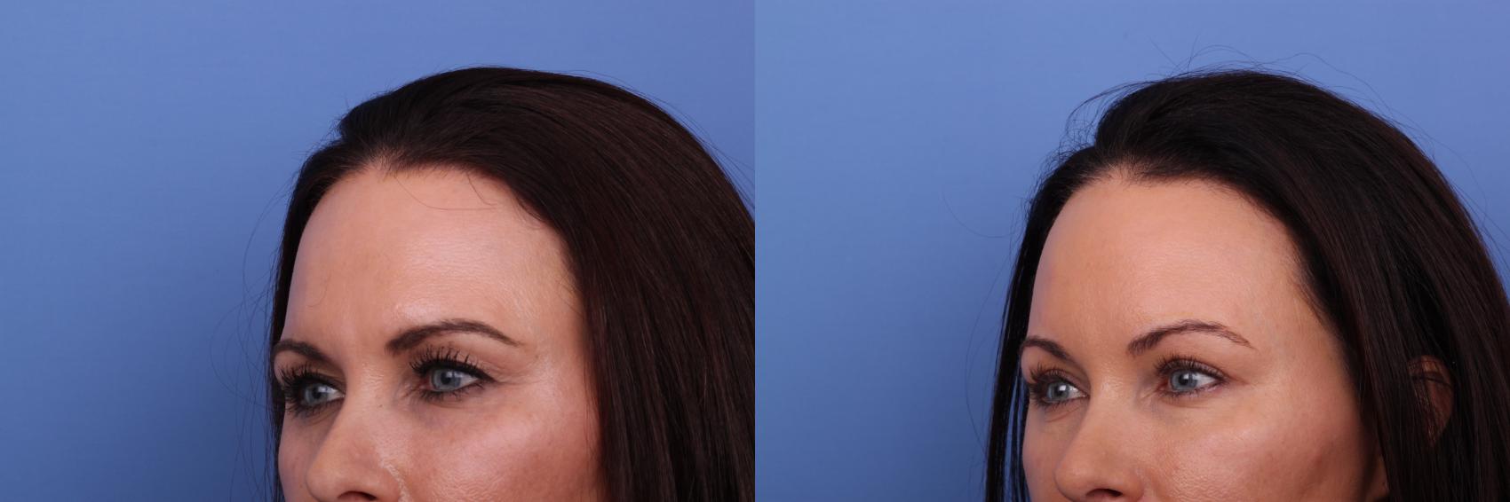 Before & After Blepharoplasty Case 597 Left Oblique View in Scottsdale, AZ