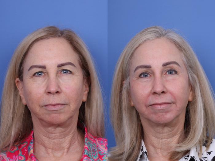 Before & After Blepharoplasty Case 719 Front View in Scottsdale, AZ