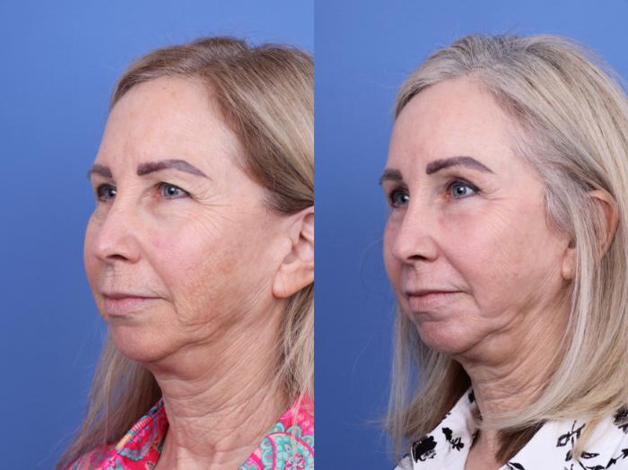 Before & After Blepharoplasty Case 719 Left Side View in Scottsdale, AZ