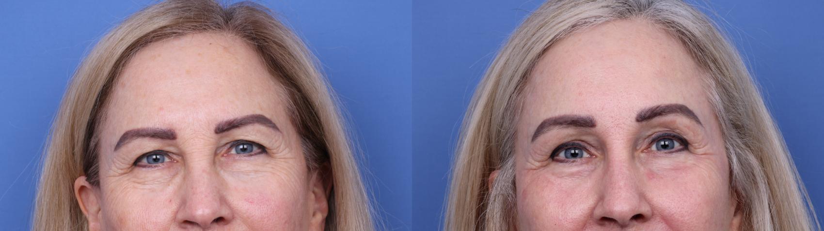 Before & After Blepharoplasty Case 719 Zoom Blepharoplasty View in Scottsdale, AZ