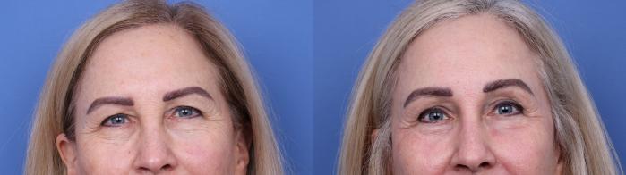 Before & After Blepharoplasty Case 719 Zoom Blepharoplasty View in Scottsdale, AZ