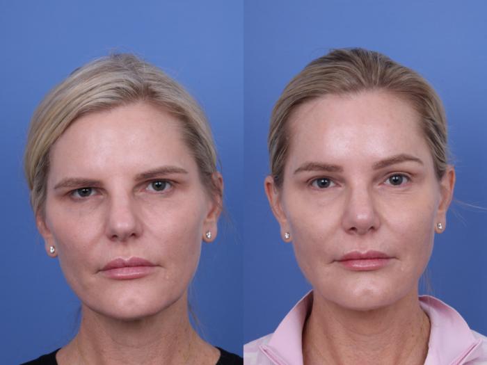 Before & After Brow Lift Case 726 Front View in Scottsdale, AZ