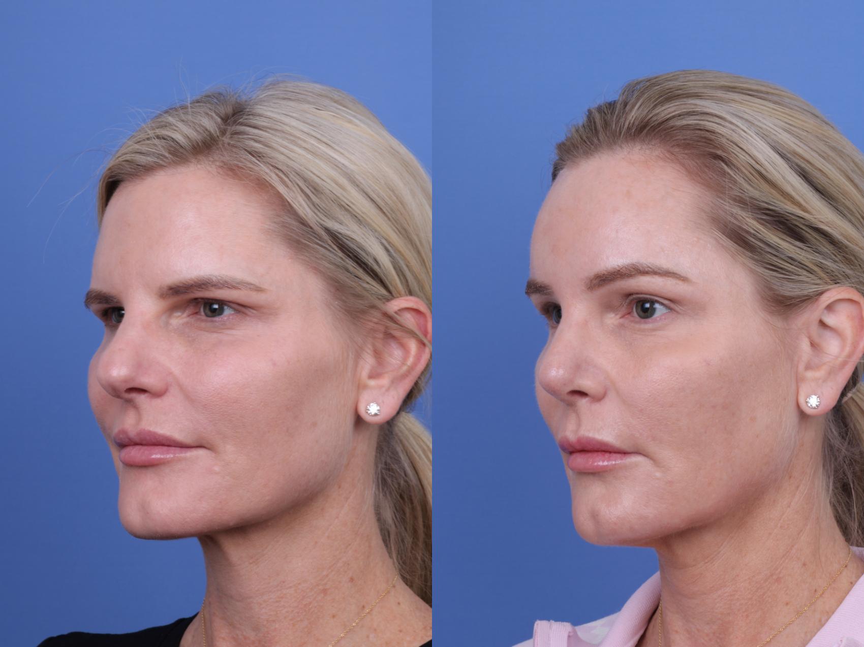 Before & After Brow Lift Case 726 Left Oblique View in Scottsdale, AZ