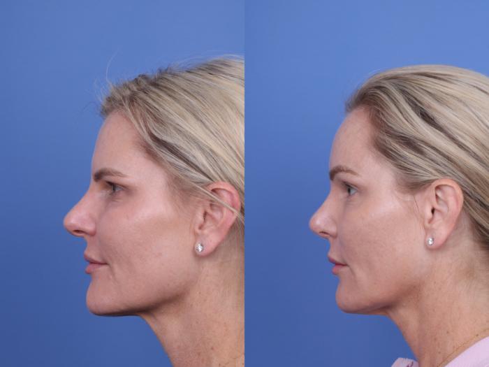 Before & After Brow Lift Case 726 Left Side View in Scottsdale, AZ