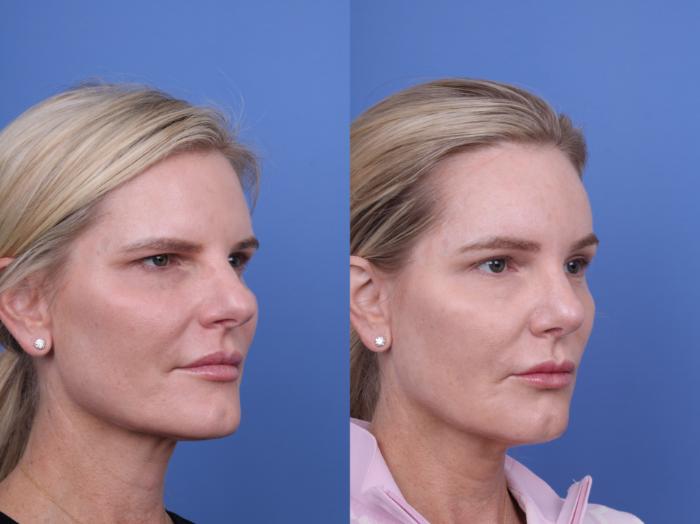 Before & After Brow Lift Case 726 Right Oblique View in Scottsdale, AZ