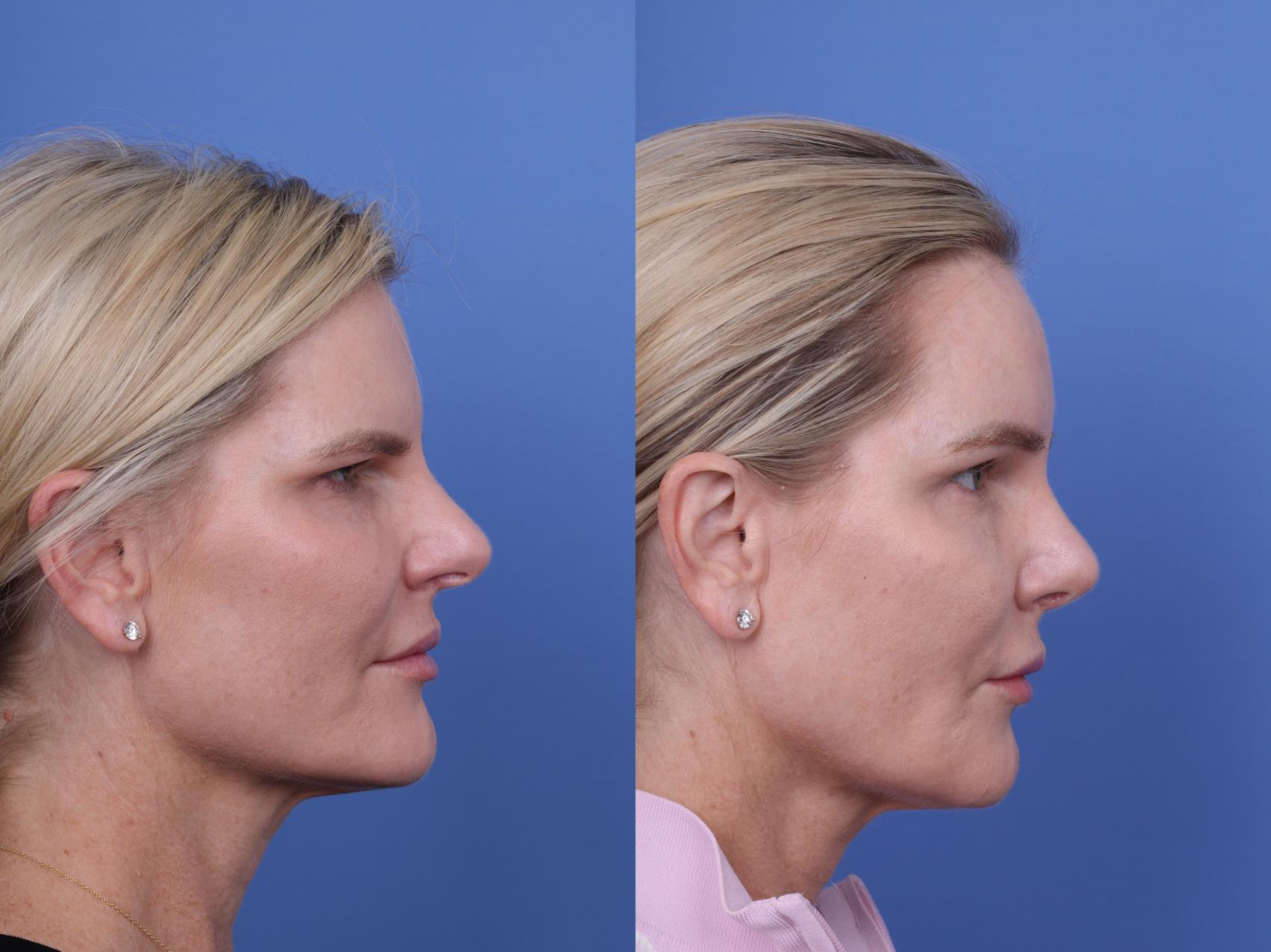 Before & After Brow Lift Case 726 Right Side View in Scottsdale, AZ