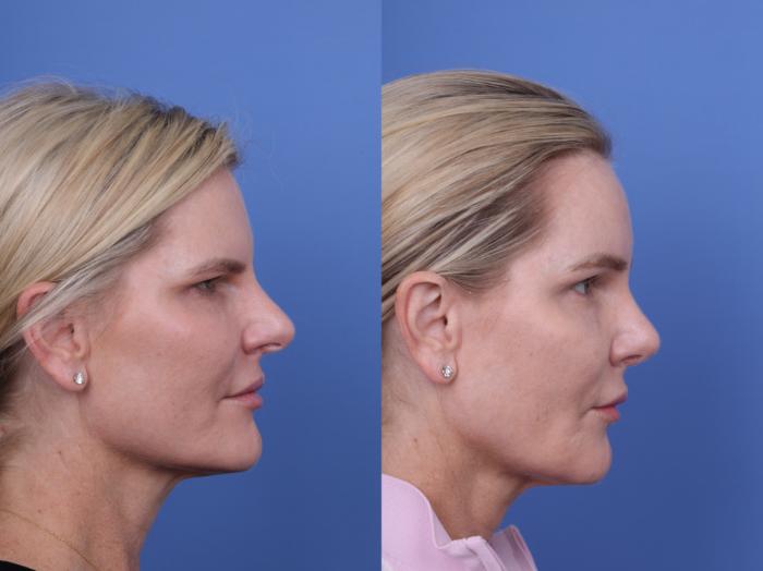 Before & After Brow Lift Case 726 Right Side View in Scottsdale, AZ
