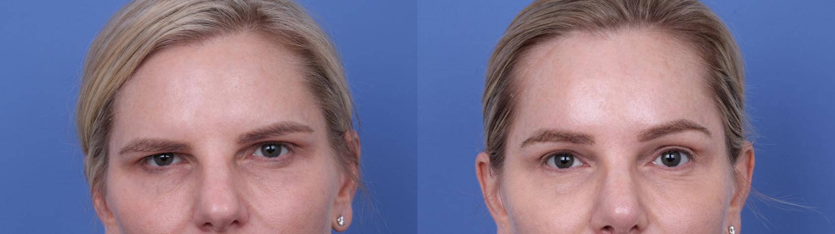 Before & After Brow Lift Case 726 Zoom Endoscopic Forehead View in Scottsdale, AZ