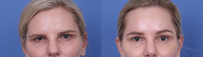 Before & After Brow Lift Case 726 Zoom Endoscopic Forehead View in Scottsdale, AZ