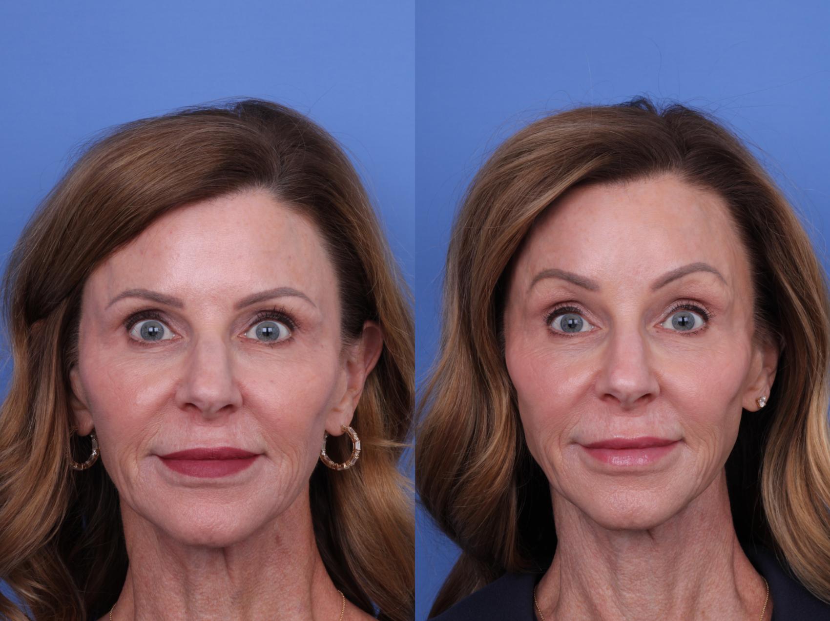Before & After Brow Lift Case 728 Front View in Scottsdale, AZ