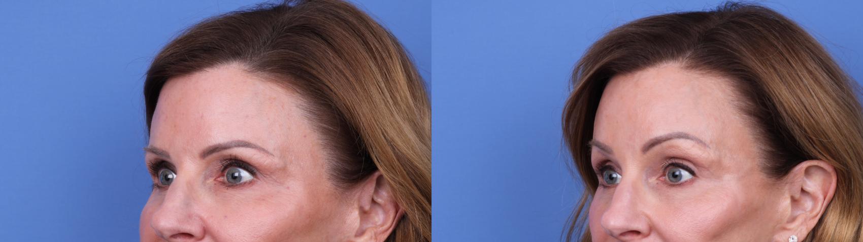 Before & After Brow Lift Case 728 Left Oblique View in Scottsdale, AZ