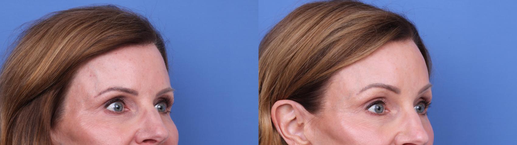Before & After Brow Lift Case 728 Right Oblique View in Scottsdale, AZ