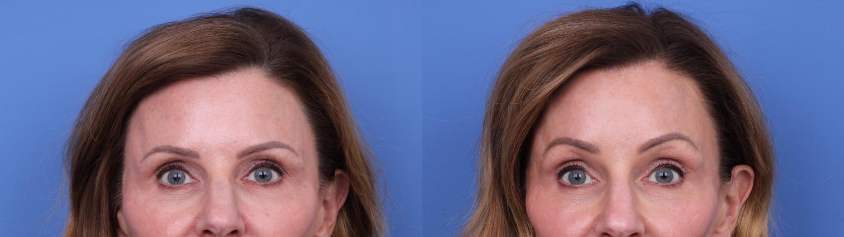 Before & After Brow Lift Case 728 Zoom Endoscopic Forehead View in Scottsdale, AZ
