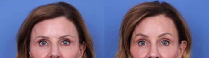 Before & After Brow Lift Case 728 Zoom Endoscopic Forehead View in Scottsdale, AZ