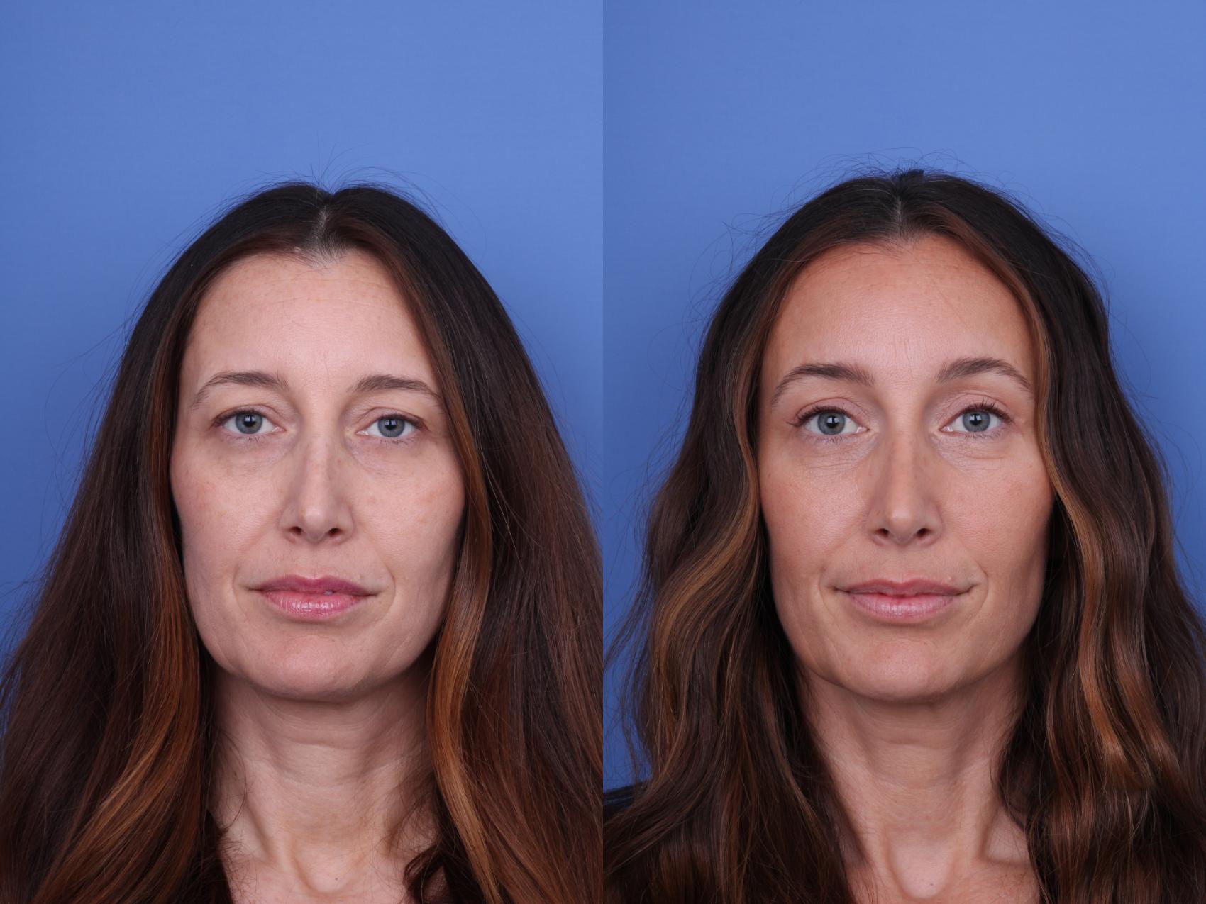Before & After Brow Lift Case 737 Front View in Scottsdale, AZ