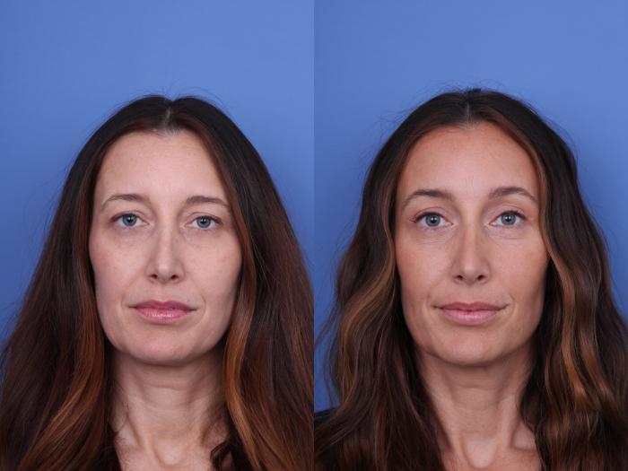 Before & After Brow Lift Case 737 Front View in Scottsdale, AZ