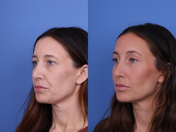 Before & After Brow Lift Case 737 Left Oblique View in Scottsdale, AZ