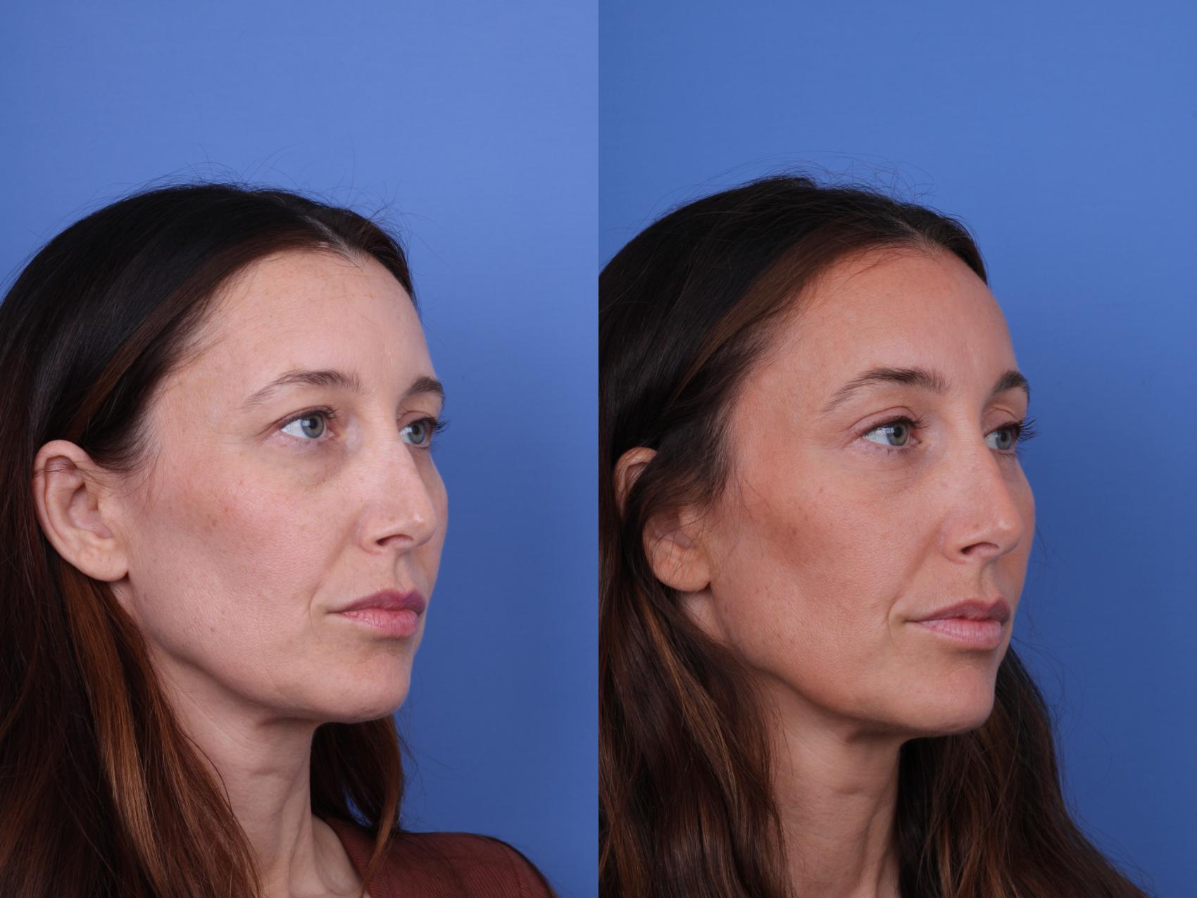 Before & After Brow Lift Case 737 Right Oblique View in Scottsdale, AZ